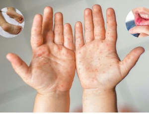 TRƯỜNG MẦM NON VIỆT TIẾN TUYÊN TRUYỀN PHÒNG, CHỐNG BỆNH TAY – CHÂN - MIỆNG TRONG TRƯỜNG MẦM NON