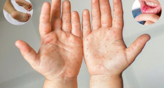 TRƯỜNG MẦM NON VIỆT TIẾN TUYÊN TRUYỀN PHÒNG, CHỐNG BỆNH TAY – CHÂN - MIỆNG TRONG TRƯỜNG MẦM NON